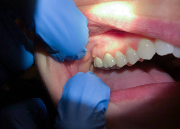 Best Emergency Dental Extractions in Alton, IL